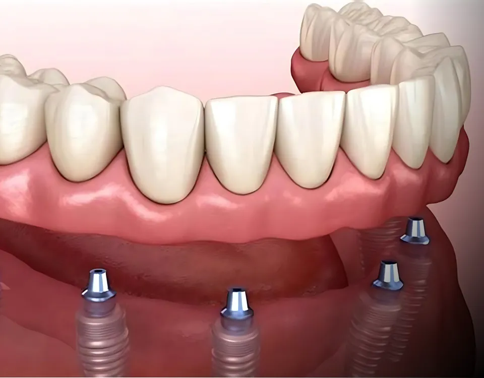 Full Mouth Reconstruction